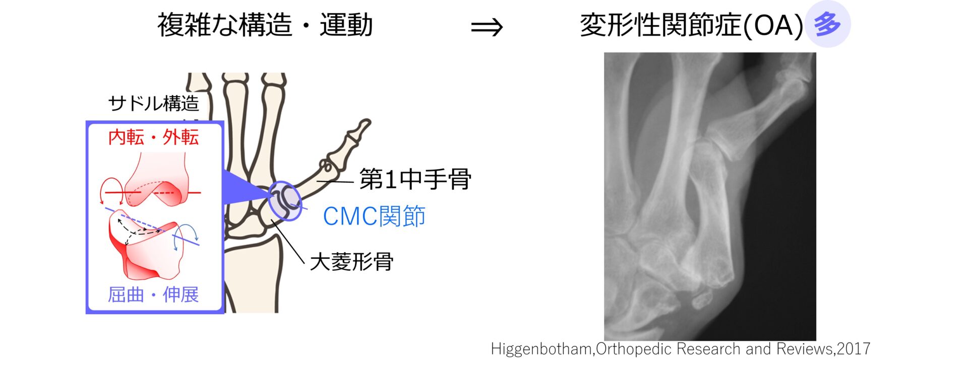 母指CM関節